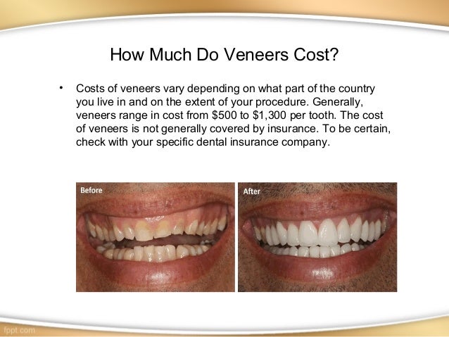 Dental veneers can give pleasing smile