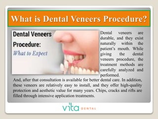 Dental Veneers Treatment- Complete Guide PPTX