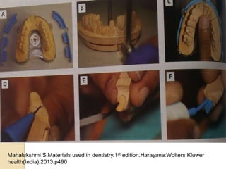 Mahalakshmi S.Materials used in dentistry.1st edition.Harayana:Wolters Kluwer
health(India);2013.p490
 
