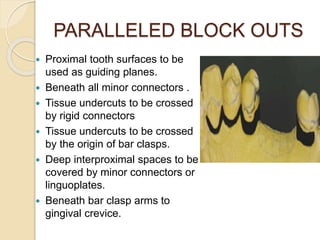 PARALLELED BLOCK OUTS
 Proximal tooth surfaces to be
used as guiding planes.
 Beneath all minor connectors .
 Tissue undercuts to be crossed
by rigid connectors
 Tissue undercuts to be crossed
by the origin of bar clasps.
 Deep interproximal spaces to be
covered by minor connectors or
linguoplates.
 Beneath bar clasp arms to
gingival crevice.
 
