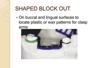 SHAPED BLOCK OUT
 On buccal and lingual surfaces to
locate plastic or wax patterns for clasp
arms
 