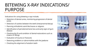 Bitewing X Rays Cnn Comprehensive Overview of Dental X-Rays: Types, Procedures, and Safety ...