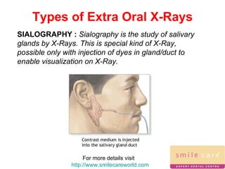For more details visit  http://www.smilecareworld.com Types of Extra Oral X-Rays SIALOGRAPHY :  Sialography is the study of salivary glands by X-Rays. This is special kind of X-Ray, possible only with injection of dyes in gland/duct to enable visualization on X-Ray. 