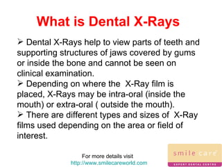 What is Dental X-Rays For more details visit  http://www.smilecareworld.com Dental X-Rays help to view parts of teeth and supporting structures of jaws covered by gums or inside the bone and cannot be seen on clinical examination.  Depending on where the  X-Ray film is placed, X-Rays may be intra-oral (inside the mouth) or extra-oral ( outside the mouth). There are different types and sizes of  X-Ray films used depending on the area or field of interest. 