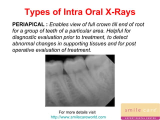 For more details visit  http://www.smilecareworld.com Types of Intra Oral X-Rays PERIAPICAL :  Enables view of full crown till end of root for a group of teeth of a particular area. Helpful for diagnostic evaluation prior to treatment, to detect abnormal changes in supporting tissues and for post operative evaluation of treatment. 