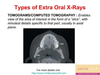 For more details visit  http://www.smilecareworld.com Types of Extra Oral X-Rays TOMOGRAMS/COMPUTED TOMOGRAPHY :  Enables view of the area of interest in the form of a “slice”, with minutest details specific to that part, usually in axial plane. 