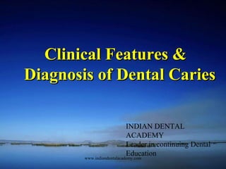 Clinical Features &Clinical Features &
Diagnosis of Dental CariesDiagnosis of Dental Caries
INDIAN DENTAL
ACADEMY
Leader in continuing Dental
Education
www.indiandentalacademy.com
 