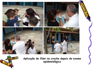 Aplicação de flúor na creche depois do exame
                epidemiológico
 