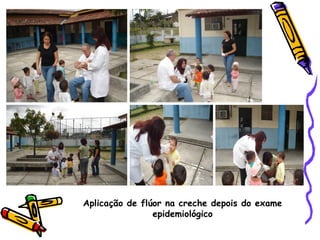 Aplicação de flúor na creche depois do exame
                epidemiológico
 