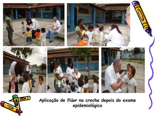 Aplicação de flúor na creche depois do exame
                epidemiológico
 