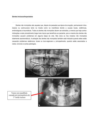 Dentes Inclusos/ImpactadosDentes não irrompidos são aqueles que, depois de passada sua época de erupção, permanecem intra-ósseos ou submucosos tanto na maxila como na mandíbula devido a causas locais, sistêmicas, embriológicas e traumáticas. Todos os dentes não irrompidos devem ser extraídos, a menos que haja contra-indicações e este procedimento traga mais riscos que benefícios ao paciente, pois a maioria dos dentes não irrompidos causam problemas em alguma etapa da vida. São raros os 3os molares não irrompidos totalmente assintomáticos. A extração dos dentes não irrompidos também está indicada quando estes estão causando problemas sistêmicos, locais ou loco-regionais e, principalmente, quando estão associados a cistos, tumores e outras patologias.<br />Tumor em mandíbula causado pro permanência de 3° molar incluso21145502469515102870069215<br />