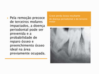 Grave perda óssea resultante
de doença periodontal e do terceiro
molar
 Pela remoção precoce
de terceiros molares
impactados, a doença
periodontal pode ser
prevenida e a
probabilidade de
reparo ósseo e
preenchimento ósseo
ideal na área
previamente ocupada.
 