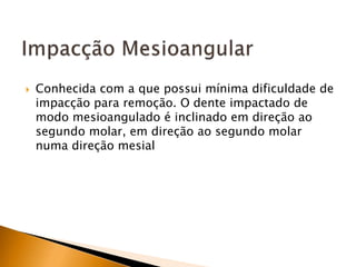  Conhecida com a que possui mínima dificuldade de
impacção para remoção. O dente impactado de
modo mesioangulado é inclinado em direção ao
segundo molar, em direção ao segundo molar
numa direção mesial
 