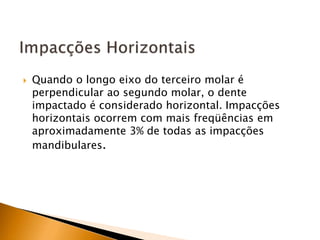  Quando o longo eixo do terceiro molar é
perpendicular ao segundo molar, o dente
impactado é considerado horizontal. Impacções
horizontais ocorrem com mais freqüências em
aproximadamente 3% de todas as impacções
mandibulares.
 