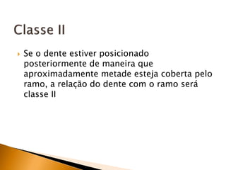  Se o dente estiver posicionado
posteriormente de maneira que
aproximadamente metade esteja coberta pelo
ramo, a relação do dente com o ramo será
classe II
 