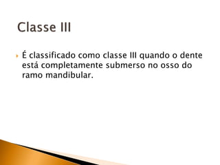  É classificado como classe III quando o dente
está completamente submerso no osso do
ramo mandibular.
 