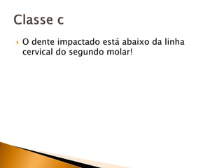  O dente impactado está abaixo da linha
cervical do segundo molar!
 
