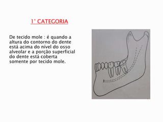 1° CATEGORIA
De tecido mole : é quando a
altura do contorno do dente
está acima do nível do osso
alveolar e a porção superficial
do dente está coberta
somente por tecido mole.
 