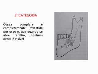 3° CATEGORIA
Óssea completa é
completamente revestida
por osso e, que quando se
abre retalho, nenhum
dente é visível
 