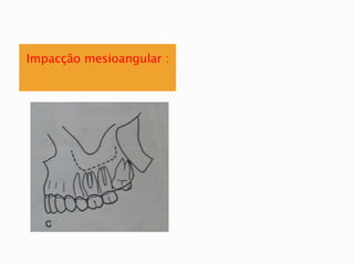 Impacção mesioangular :
 