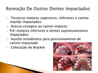  Terceiros molares superiores, inferiores e canino
maxilar impactados:
 Acesso cirúrgico ao canino impacto :
 Pré-molares inferiores e dentes supranumerários
impactados:
 Auxílio ortodôntico para posicionamento de
canino impactado
 Colocação do Bracket
 