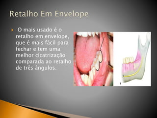  O mais usado é o
retalho em envelope,
que é mais fácil para
fechar e tem uma
melhor cicatrização
comparada ao retalho
de três ângulos.
 