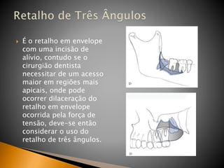  É o retalho em envelope
com uma incisão de
alívio, contudo se o
cirurgião dentista
necessitar de um acesso
maior em regiões mais
apicais, onde pode
ocorrer dilaceração do
retalho em envelope
ocorrida pela força de
tensão, deve-se então
considerar o uso do
retalho de três ângulos.
 