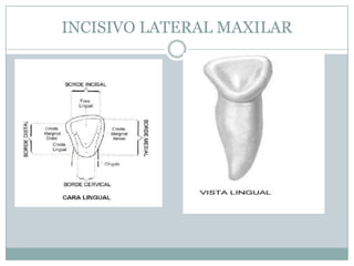 INCISIVO LATERAL MAXILAR
 