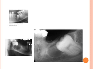Dentigerous cyst