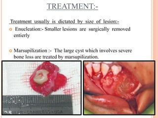 TREATMENT:-
Treatment usually is dictated by size of lesion:-
 Enucleation:- Smaller lesions are surgically removed
entierly
 Marsupilization :- The large cyst which involves severe
bone loss are treated by marsupilization.
 