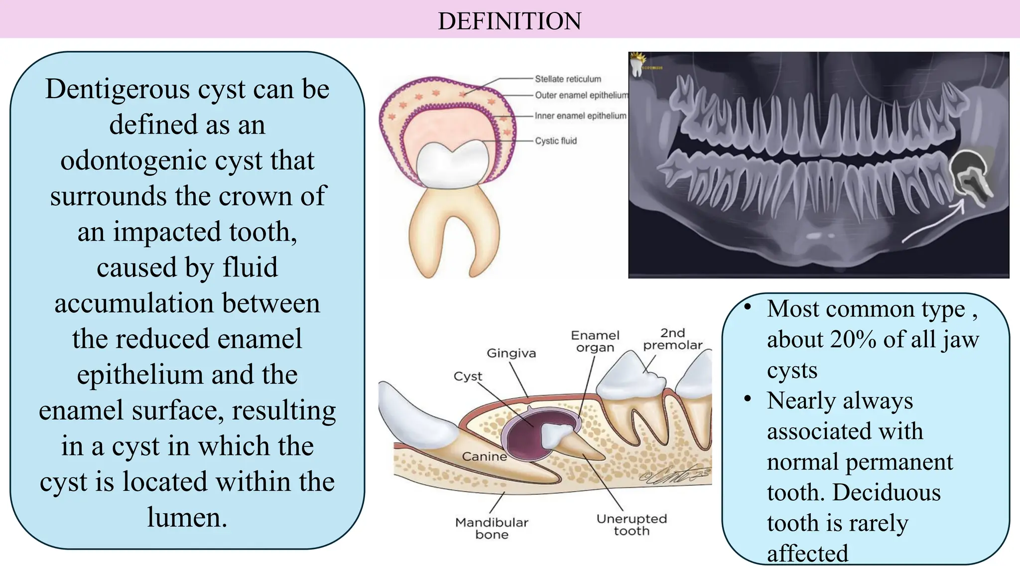 DENTIGEROUS CYST (FOLLICULAR CYST) PPT | PPTX