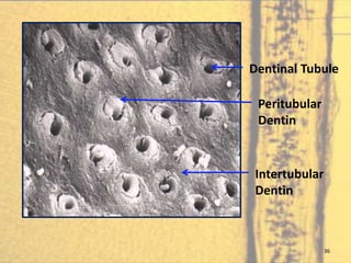 Translucent Dentin Intratubular Dentin