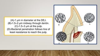 (A)-1 μm in diameter at the DEJ.
(B)-1.5–2 μm midway through dentin.
(C)-1.5–3 μm at the pulp.
(D)-Bacterial penetration follows line of
least resistance to reach the pulp.
 