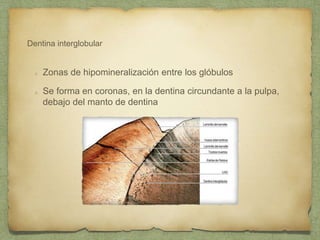 Dentina interglobular
Zonas de hipomineralización entre los glóbulos
Se forma en coronas, en la dentina circundante a la pulpa,
debajo del manto de dentina
 