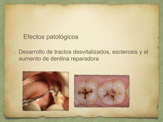 Desarrollo de tractos desvitalizados, esclerosis y el
aumento de dentina reparadora
Efectos patológicos
 
