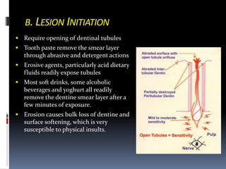 B. LESION INITIATION
 Require opening of dentinal tubules
 Tooth paste remove the smear layer
through abrasive and detergent actions
 Erosive agents, particularly acid dietary
fluids readily expose tubules
 Most soft drinks, some alcoholic
beverages and yoghurt all readily
remove the dentine smear layer after a
few minutes of exposure.
 Erosion causes bulk loss of dentine and
surface softening, which is very
susceptible to physical insults.
 