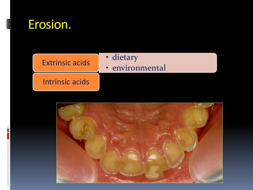 Dentinal hypersensitivity