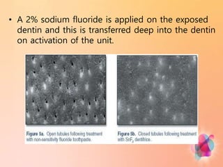 • A 2% sodium fluoride is applied on the exposed
dentin and this is transferred deep into the dentin
on activation of the unit.
 