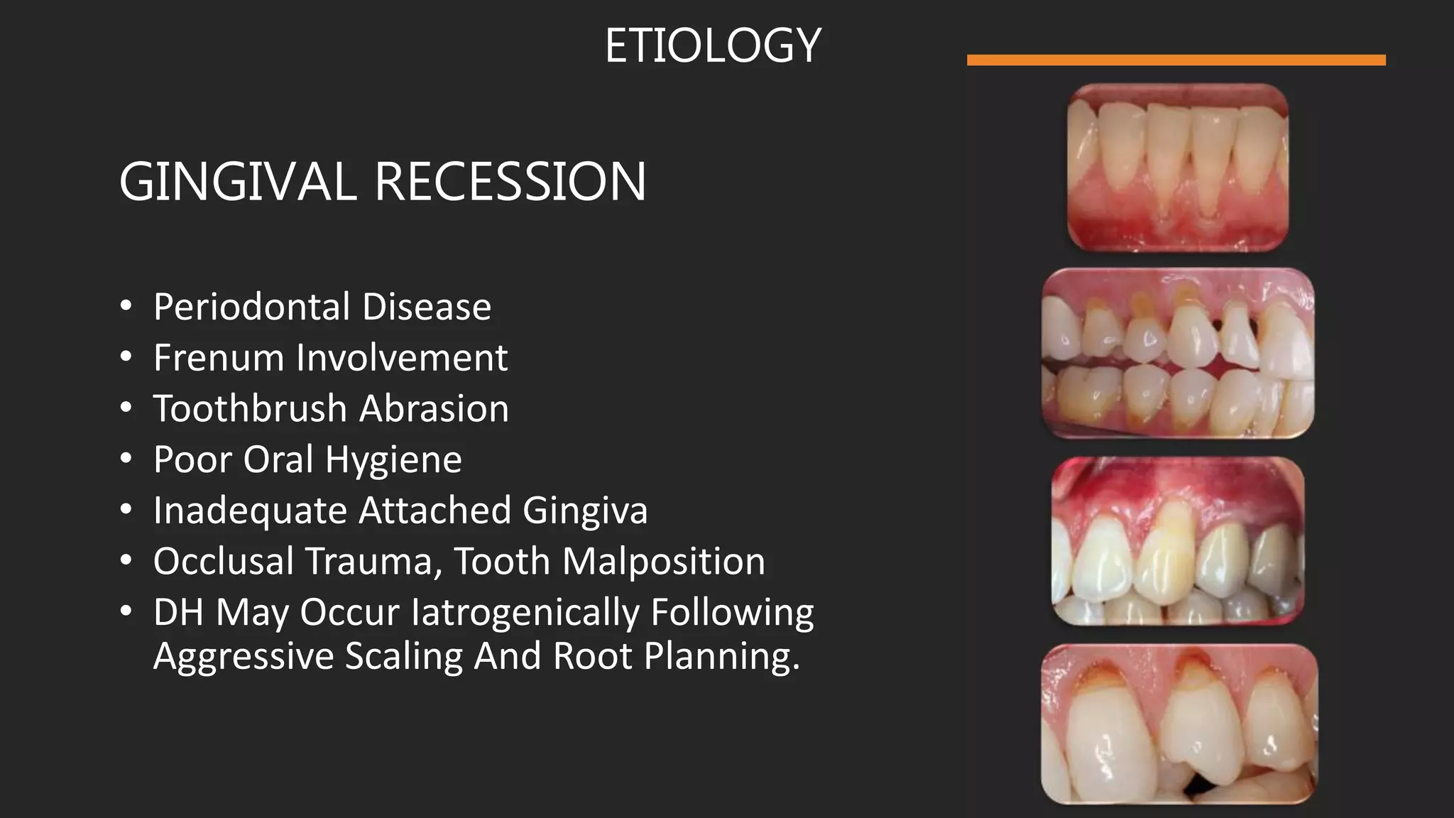 Dentinal Hypersensitivity | PPTX