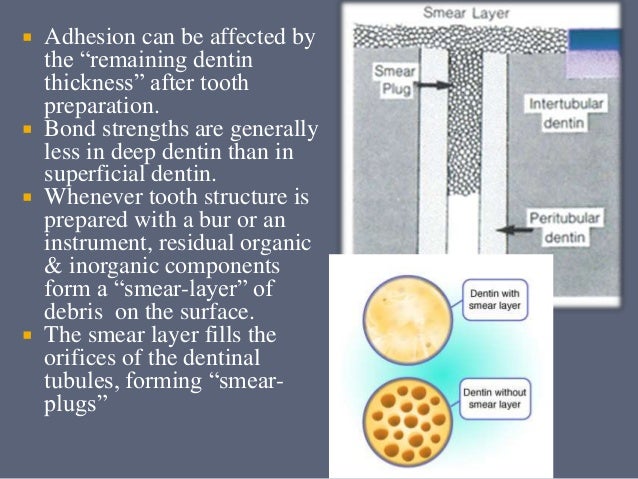 types of dental bonding agents dentin-bonding-agents-36-638.jpg?cb=1430934575 types of dental bonding agents dentin-bonding-agents-36-638.jpg?cb=1430934575