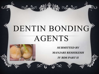 DENTIN BONDING
AGENTS
SUBMITTED BY
MANJARI RESHIKESH
IV BDS PART II
 