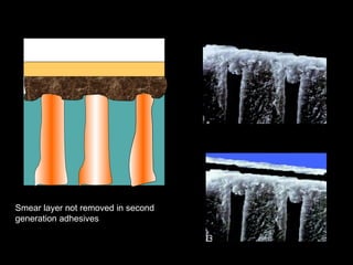 Smearing Adhesion Example Dentin Bonding Systems in operative dentistry | PPT