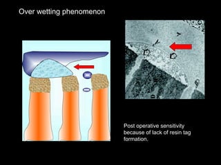Dentin Bonding Systems in operative dentistry | PPT