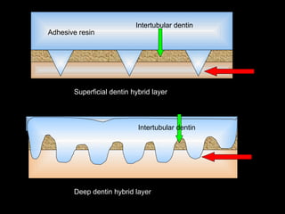 Dentin Bonding Systems in operative dentistry | PPT