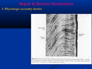 Repair & Defence Mechanisms
I. Physiologic secondry dentin:
 