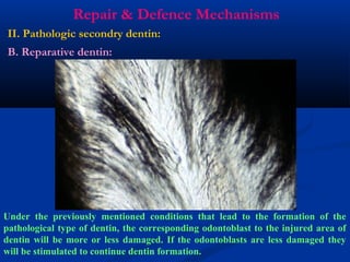 Repair & Defence Mechanisms
II. Pathologic secondry dentin:
B. Reparative dentin:
Under the previously mentioned conditions that lead to the formation of the
pathological type of dentin, the corresponding odontoblast to the injured area of
dentin will be more or less damaged. If the odontoblasts are less damaged they
will be stimulated to continue dentin formation.
 