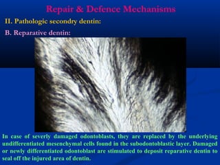 Repair & Defence Mechanisms
II. Pathologic secondry dentin:
B. Reparative dentin:
In case of severly damaged odontoblasts, they are replaced by the underlying
undifferentiated mesenchymal cells found in the subodontoblastic layer. Damaged
or newly differentiated odontoblast are stimulated to deposit reparative dentin to
seal off the injured area of dentin.
 