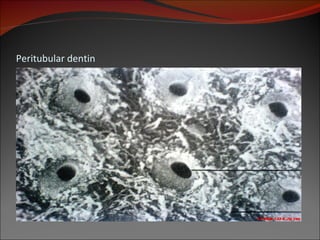 Peritubular dentin 