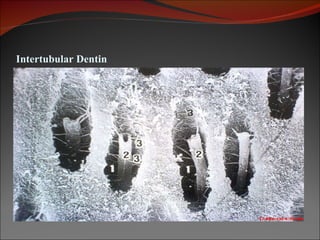 Intertubular Dentin 