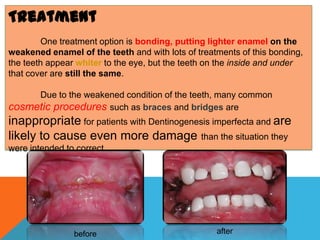 Treatment
        One treatment option is bonding, putting lighter enamel on the
weakened enamel of the teeth and with lots of treatments of this bonding,
the teeth appear whiter to the eye, but the teeth on the inside and under
that cover are still the same.

     Due to the weakened condition of the teeth, many common
cosmetic procedures such as braces and bridges are
inappropriate for patients with Dentinogenesis imperfecta and are
likely to cause even more damage than the situation they
were intended to correct.




                before                             after
 